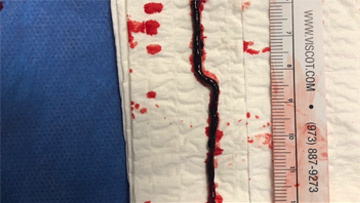 Removal of a 11cm thrombus!