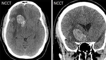 Retrieval of herniated coil during stent-assisted coiling