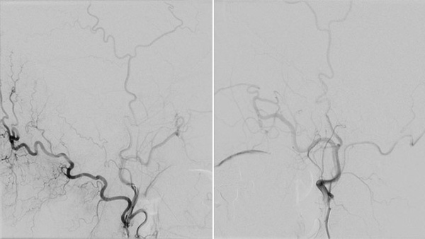 Retrograde facial vein approach in the transvenous embolization of CSDAVF