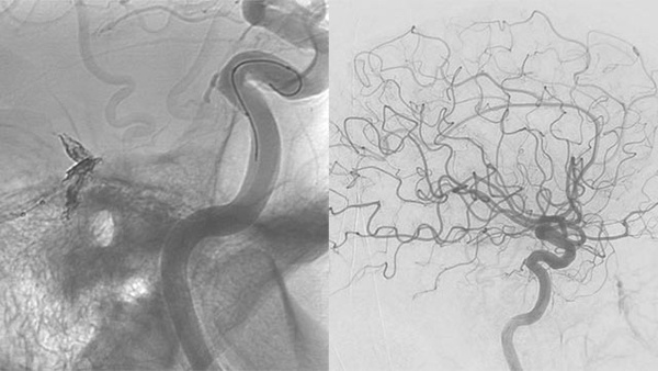 Retrograde transvenous embolization of a tentorial dural AV-Fistula