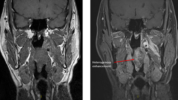RF Ablation as 1st line treatment for head & neck vascular malformation
