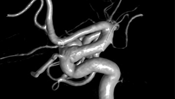 Right-sided paraophthalmic aneurysm treated with a Pipeline™ Vantage Shield using  RIST™ Radial access System