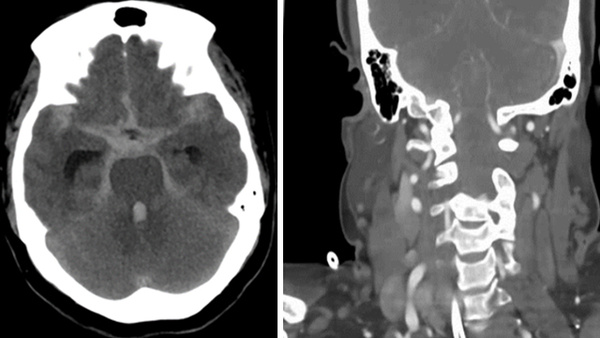 Ruptured bilateral spontaneous intradural vertebral artery dissection [V4 segment False aneurysm formation] treated by flow-diverter with a special caution of the fish-mouth phenomena