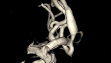 Ruptured dissecting aneurysm treated on day 0 with Pipeline-Shield and coils on aspirin only