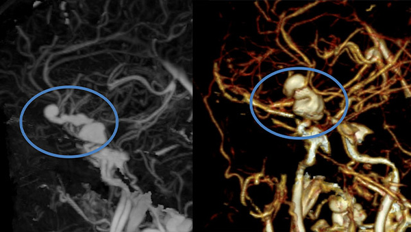 Ruptured serpentine ACA aneurysm & parent artery occlusion