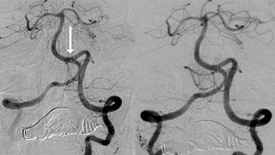 Second stroke patient treated with Cyclical Aspiration
