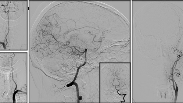Sequential asymptomatic intracranial atherosclerosis (ICAD) - to be treated, or not