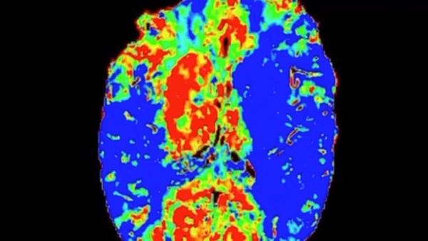 Simultaneous bilateral mechanical thrombectomies on a patient Covid positive