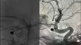 Single Coil Embolization for Treatment of Post-op Intrasellar Pseudoaneurysm