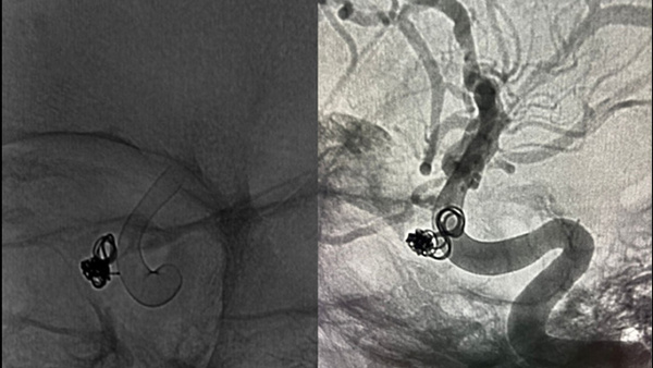 Single Coil Embolization for Treatment of Post-op Intrasellar Pseudoaneurysm