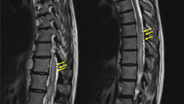 Spinal epidural arteriovenous fistula embolization