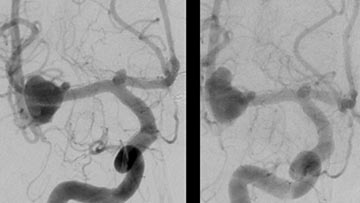 Stent-assisted WEB repair of an MCA bifurcation aneurysm