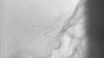 Stentretrievers in vasospasm