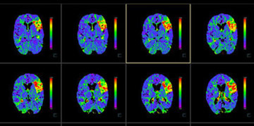 Stroke secondary to ICAD
