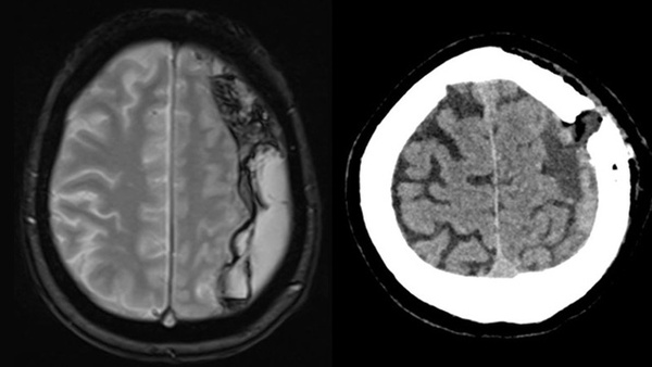 Subdural Hematoma: Preventing Recurrence with a Three-Step Onyx Embolization