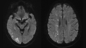 Successful cross-circulation thrombectomy for acute middle cerebral artery occlusion through posterior communicating artery: a case report