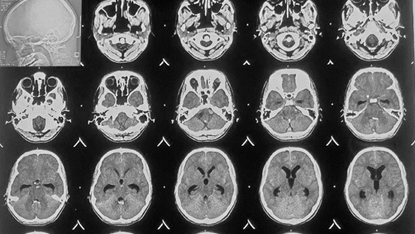 Taming the serpentine: Cervical Spinal perimedullary AVF presenting as SAH