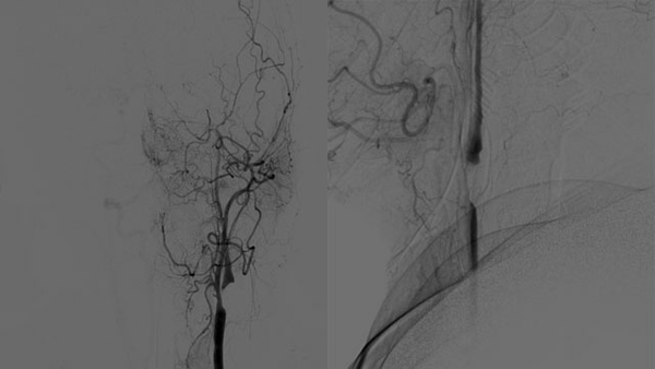 Tandem Stenosis & Extracranial Carotid Rescue Stenting