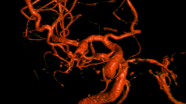 Temporal AVM embolization via double access