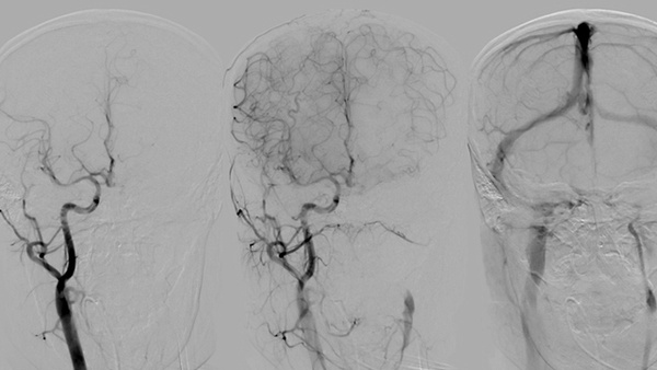 The Road not taken – a rare case of Tandem stroke