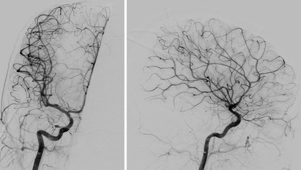The Youngest Challenge: Emergency Stenting for Pediatric Ischemic Stroke
