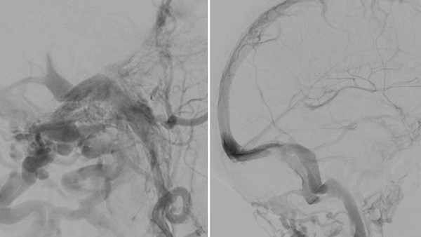 Therapy of a DAVF Cognard 2a