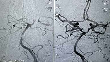 Third stroke patient treated with Cyclical Aspiration