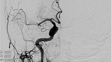 Thrombectomy - ADAPT with Snake bite technique