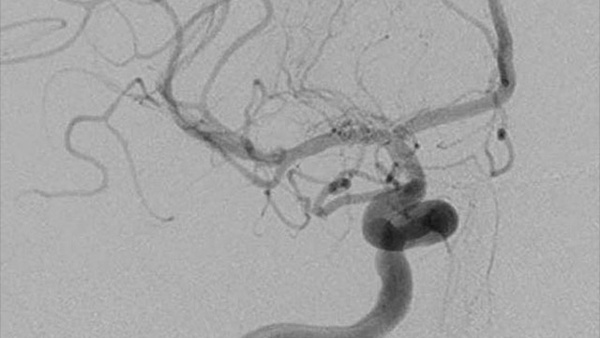 Thrombectomy - When a small succeeds where a big cannot