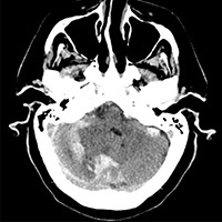 Transarterial Embolization of Straight Sinus Dural Arteriovenous Fistula