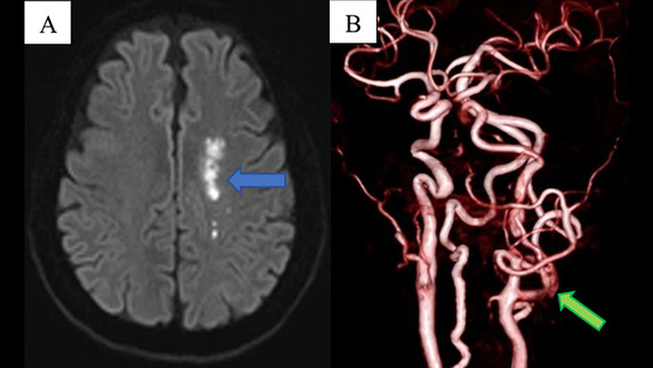 Transcervical approach for carotid artery stenting without reversal flow