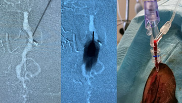 Transcranial embolization of a superficial DAVF: an alternative technique after unsuccessfull conventional approaches
