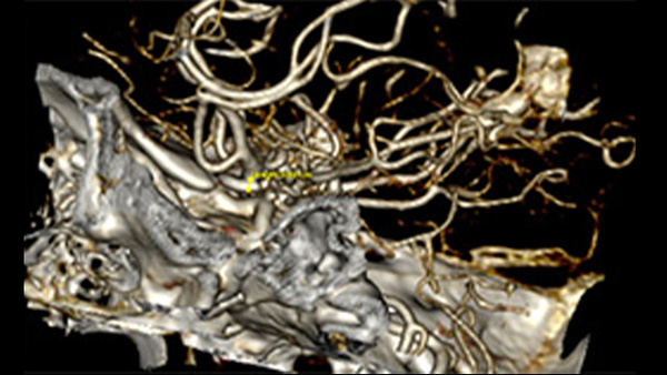 Transient Gerstmann syndrome following flow diversion of a giant left ophthalmic artery aneurysm: a case report