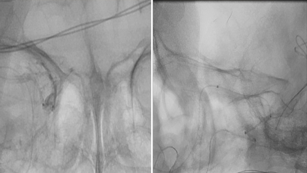 The Road not taken – a rare case of Tandem stroke