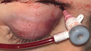 Transorbital endovascular embolization of a dural carotid-cavernous fistula