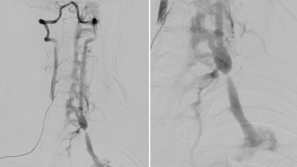 Transvenous Embolization of a Traumatic Vertebral Artery AVF Sustained from Gun Shot Wound 