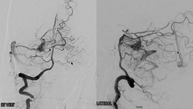 Transvenous embolization of arterio-venous malformation