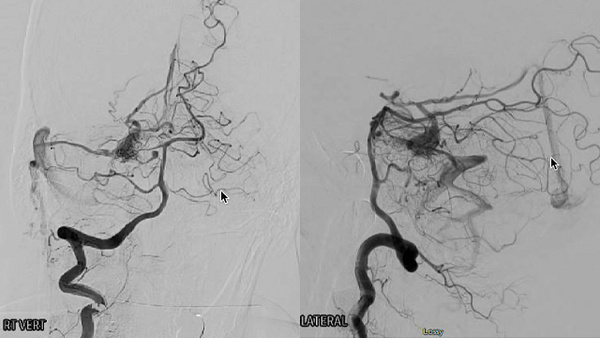 Transvenous embolization of arterio-venous malformation