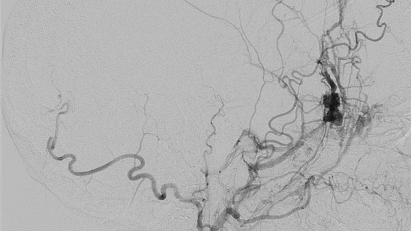 Traumatic MMA-Orbitofrontal Dural AVF Treated with Coils and Liquid Embolization	