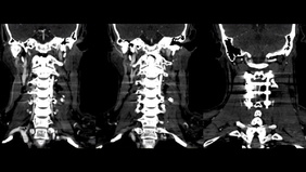 Traumatic vertebral artery transection injury
