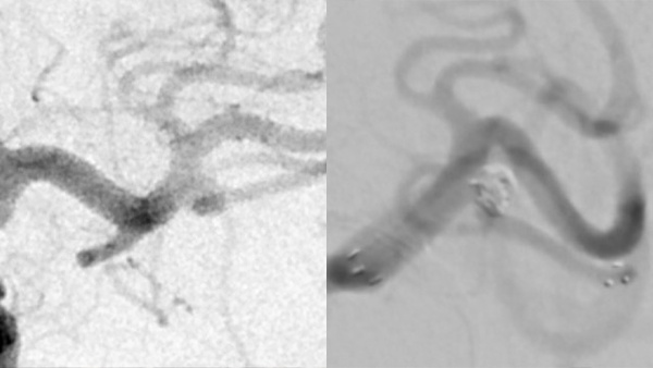 Treatment of left MCA aneurysm