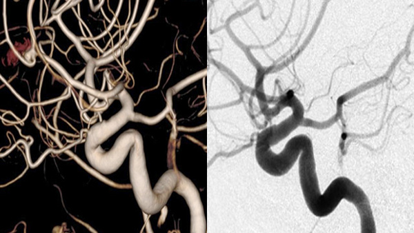 Treatment of recanalized pericallosal artery aneurysm