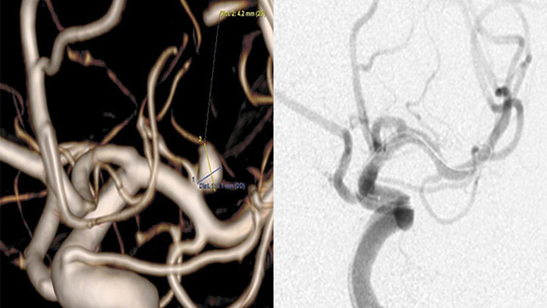 Treatment of ruptured MCA aneurysm