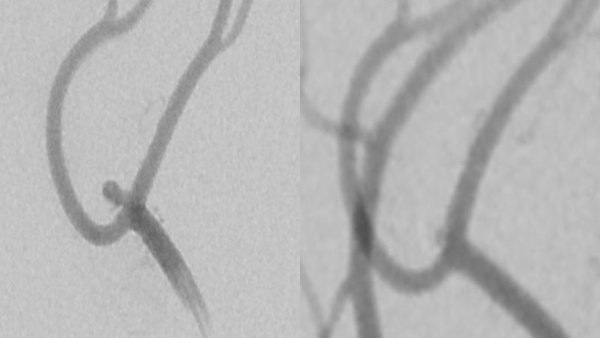 Treatment of ruptured pericallosal anterior cerebral artery aneurysm