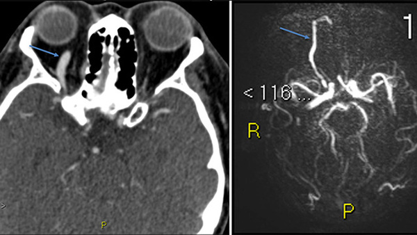 Tunnelling for gold (through an occluded SOV in CCF)