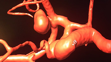 Two aneurysms on the same artery, two different treatment modalities 