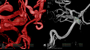 Unexpected complication of stent-assisted aneurysm coiling in presence of complex anatomical variation