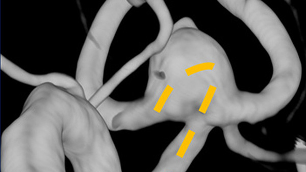 Use of a unique distal-shaped microcatheter in the treatment of a wide-neck Acom aneurysm