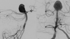 Utilizing Large Intrasaccular Device (Seal Arc) to embolize Large Basilar Tip Aneurysm