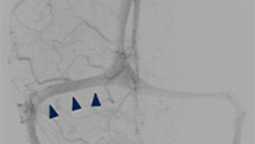 9-venous-sinus-stenting-in-idiopathic-intracranial-hypertension-teaser